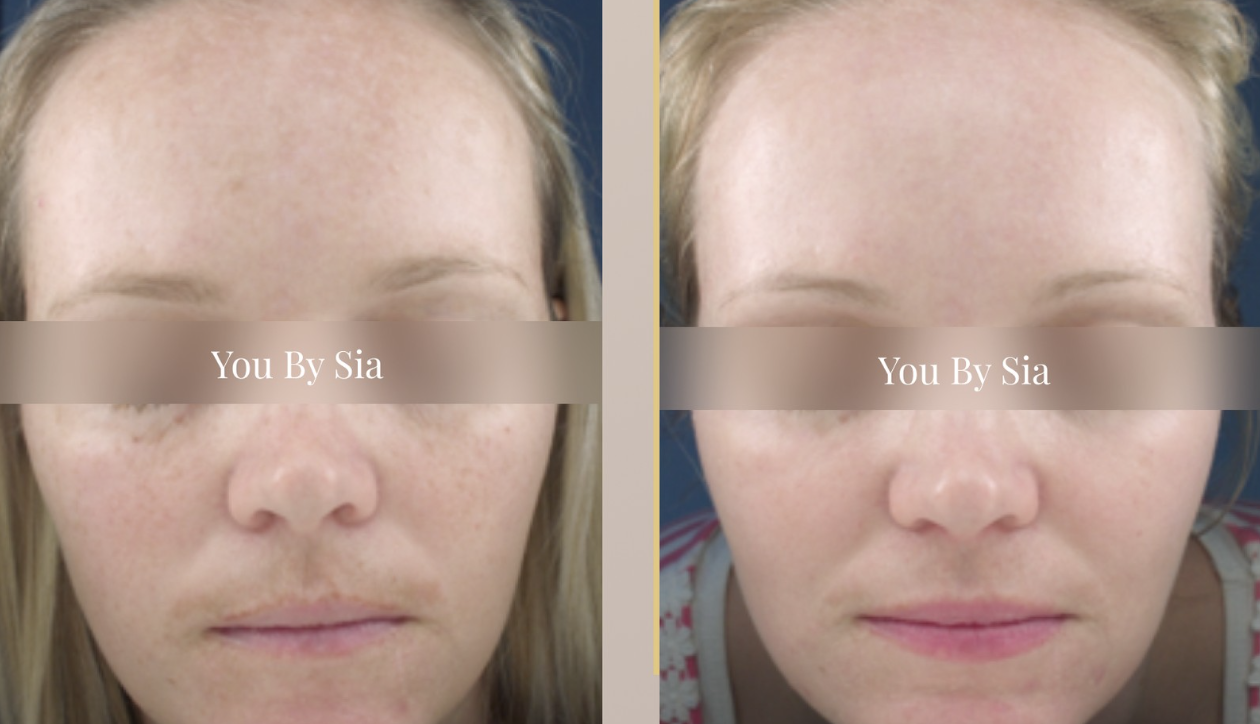 Before and after — You By Sia client
