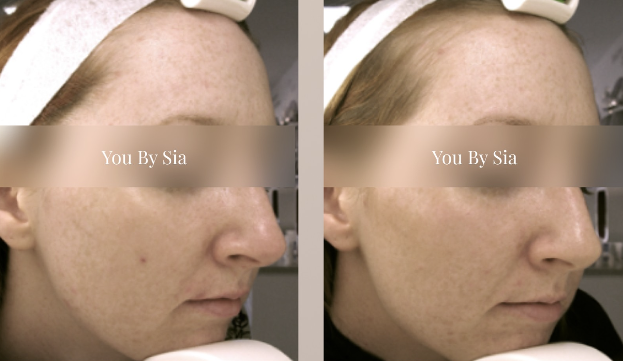 Before and after — You By Sia client